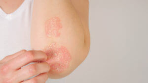 psoriasis treatment near me