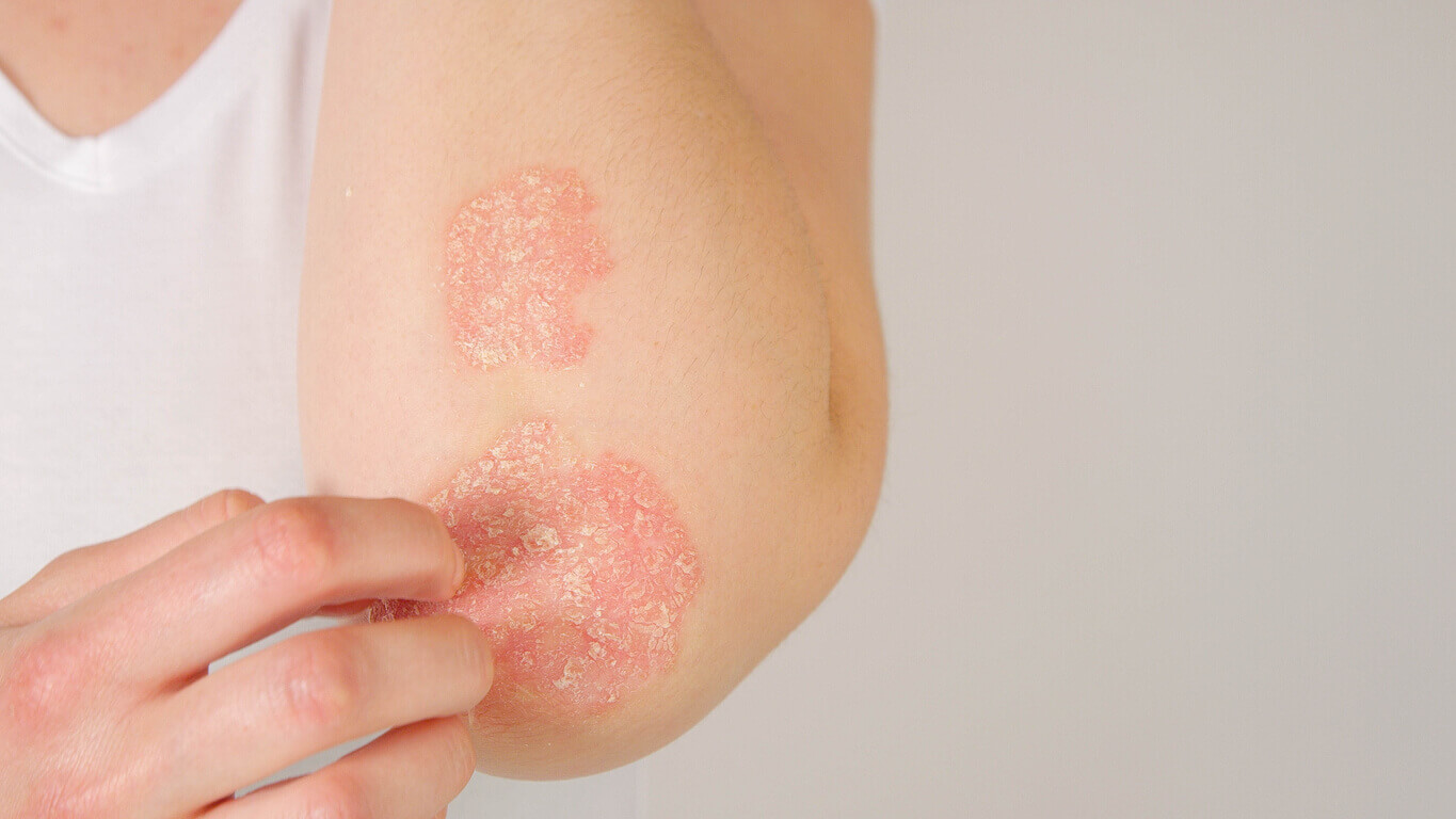 psoriasis treatment near me