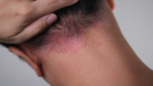psoriasis treatment