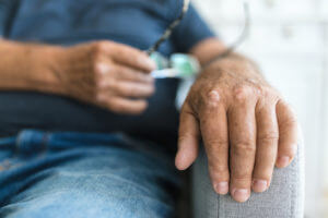 Close up of a man's hand who is suffering from Psoriatic Arthritis.