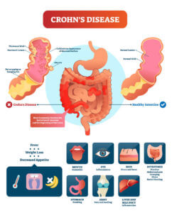 rohns disease vector illustration