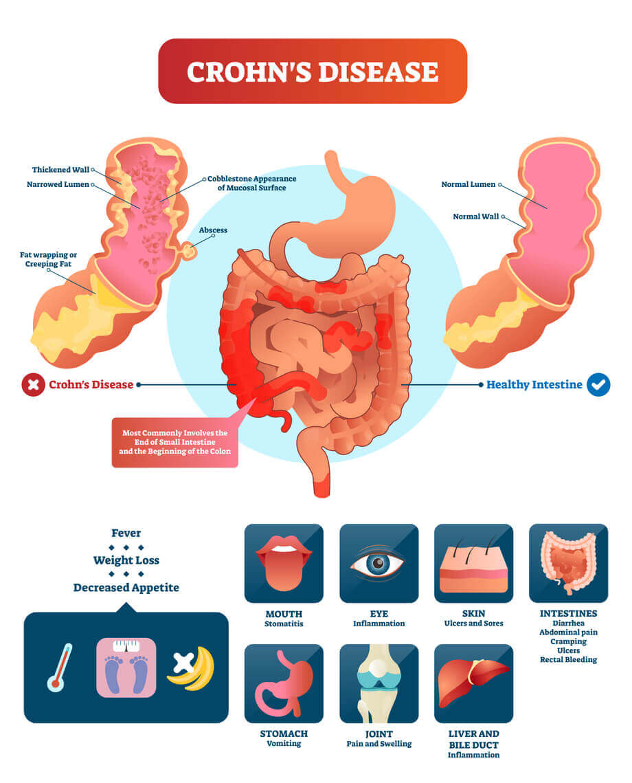 rohns disease vector illustration