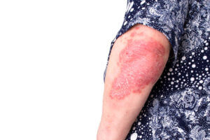An image of a person with psoriasis, a skin disease characterized by red, scaly patches.