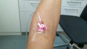Patient gets an remicade infusion into his arm.