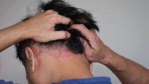 A man who is stressed by psoriasis.