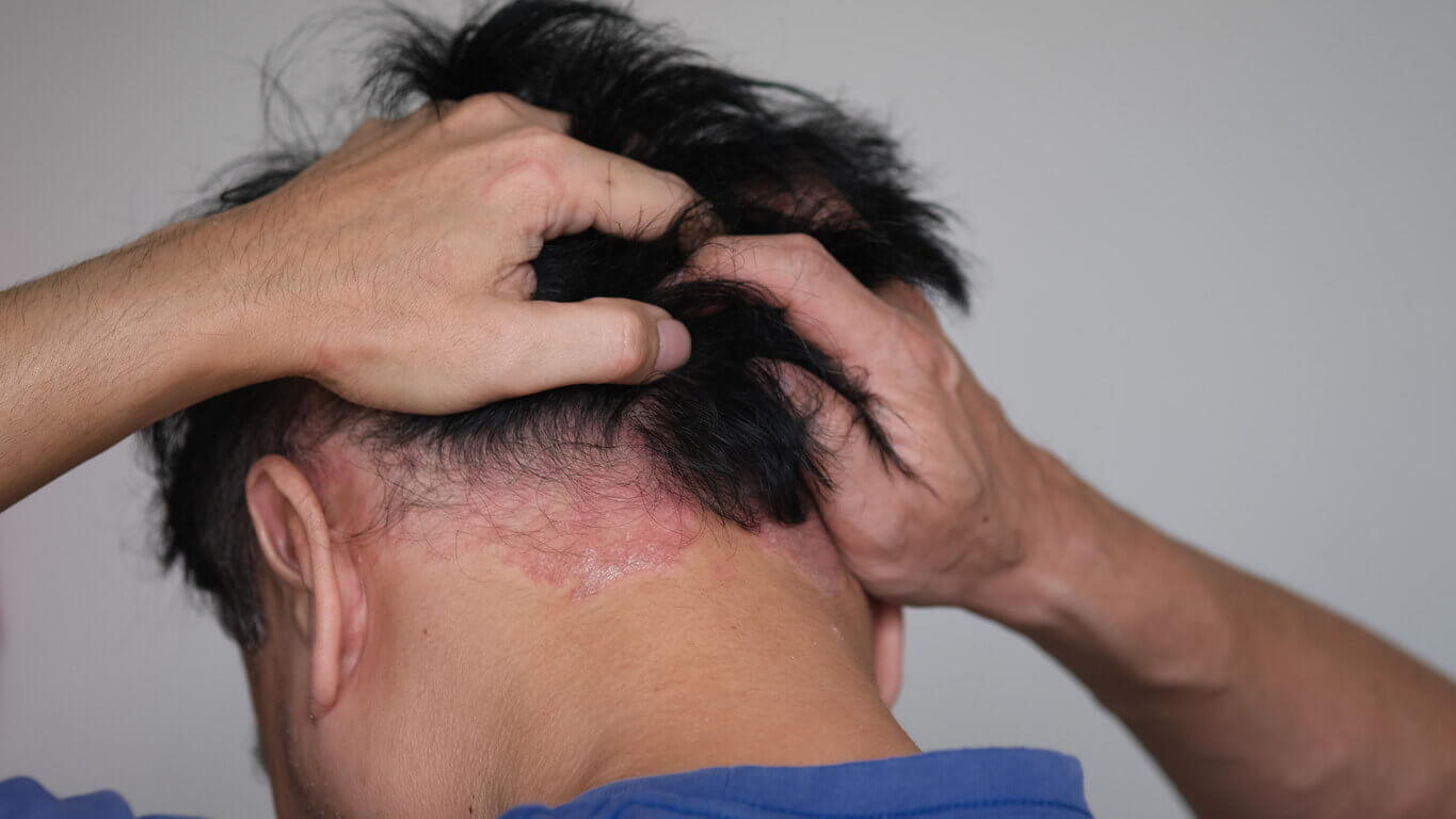 A man who is stressed by psoriasis.